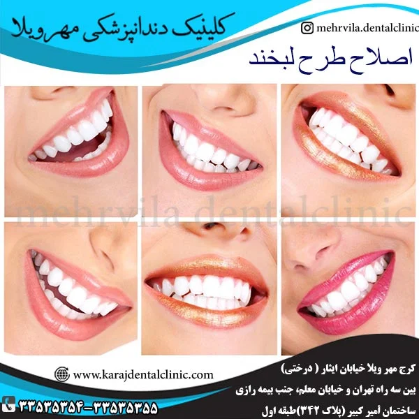 اصلاح طرح لبخند