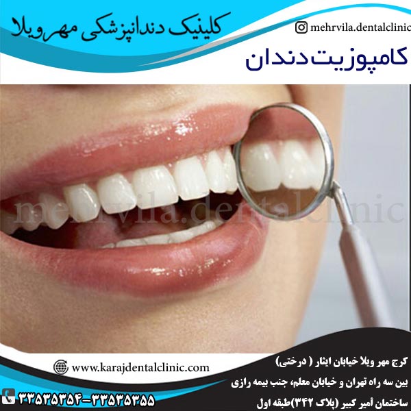 کامپوزیت دندان در کرج - کلینیک مهرویلا