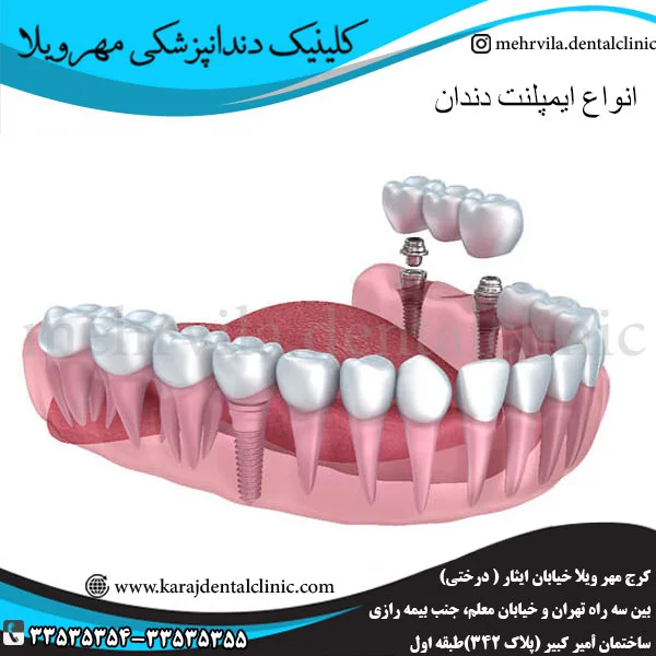 انواع ایمپلنت دندان