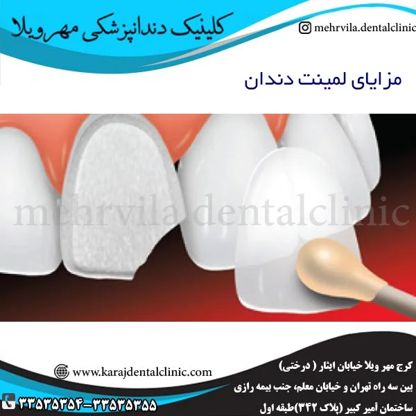 مزایای لمینت دندان