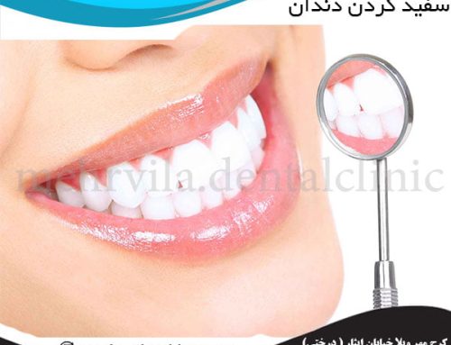 سفید کردن دندان | مزایا  و نحوه سفید کردن دندان