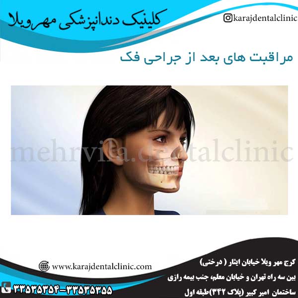 مراقبت های بعد از جراحی فک