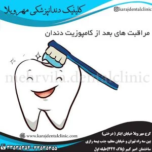 مراقبت-های-بعد-از-کامپوزیت-دندان