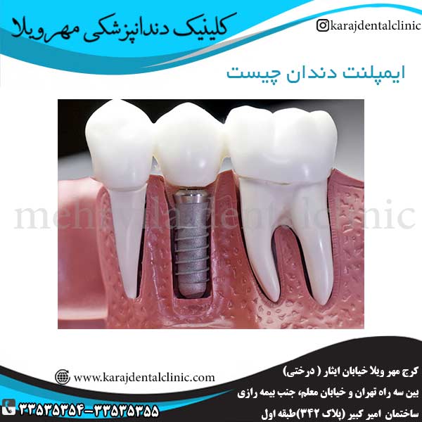 ایمپلنت دندان چیست