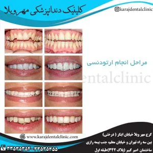 مراحل انجام ارتودنسی