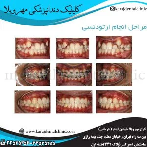مراحل انجام ارتودنسی