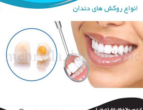 انواع روکش‌ های دندان | مزایا و معایب روکش دندان