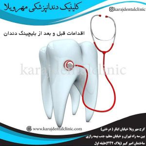 اقدامات قبل و بعد از بلیچینگ دندان