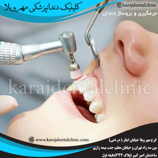 جرمگیری و بروساژ دندان