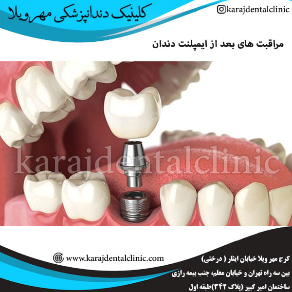 مراقبت های بعد از ایمپلنت دندان