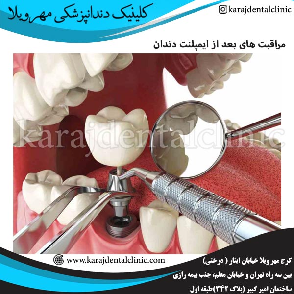 مراقبت های بعد از ایمپلنت دندان