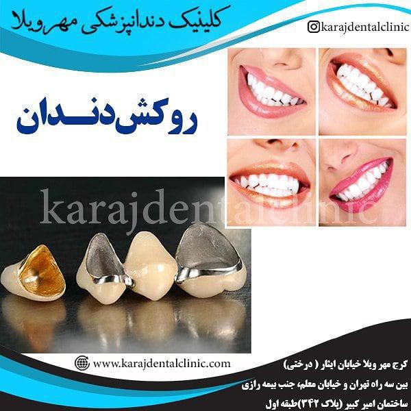 روکش دندان