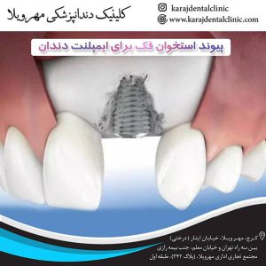 اقدامات قبل و بعد از ایمپلنت دندان