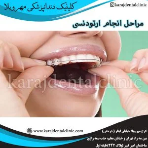 مراحل انجام ارتودنسی