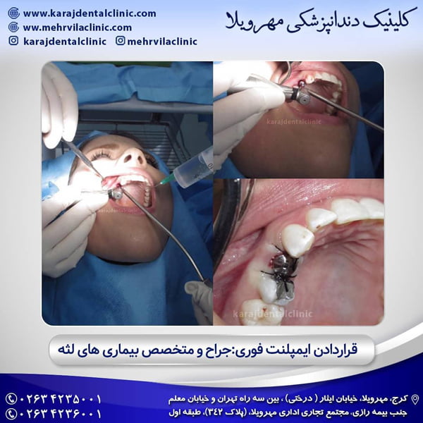 انواع ایمپلنت دندان