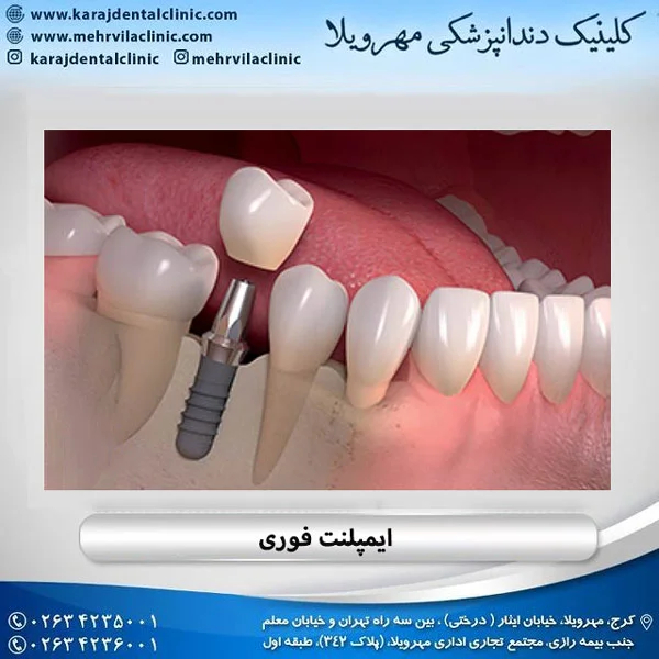 ایمپلنت فوری در کرج