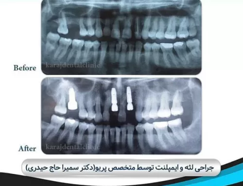 ایمپلنت چیست؟ ایمپلنت دندان در کرج | بهترین ایمپلنت