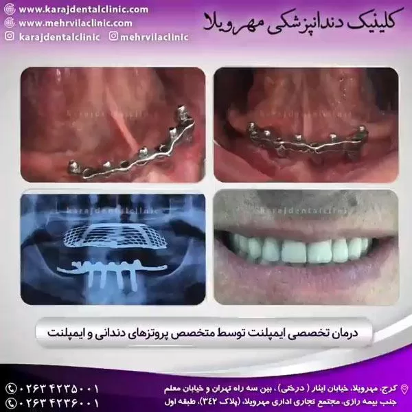 ایمپلنت کرج - کلینیک دندانپزشکی مهرویلا