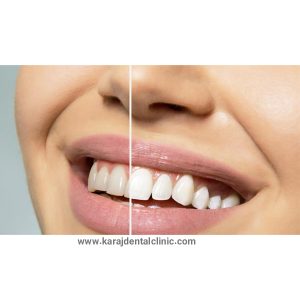 بلیچینگ دندان - https://karajdentalclinic.com/