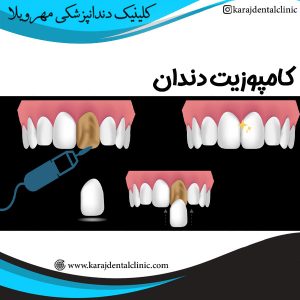کامپوزیت دندان - https://karajdentalclinic.com/