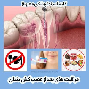 مراقبت های بعد از عصب کشی دندان - https://karajdentalclinic.com/