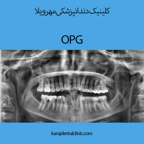 عکس او پی جی دندان https://karajdentalclinic.com/