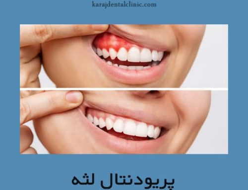 پریودنتال لثه + راه های پیشگیری و درمان بیماری لثه ای