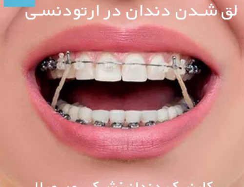 لق شدن دندان در ارتودنسی + درمان لقی دندان در ارتودنسی