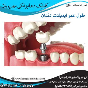 طول عمر ایمپلنت دندان _ کلینیک مهرویلا کرج