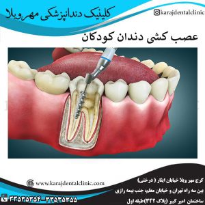 نحوه عصب کشی دندان کودکان _ کلینیک مهرویلا