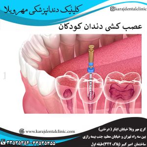 عصب کشی دندان کودکان _ کلینیک مهرویلا