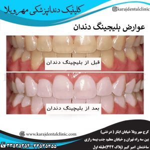 عوارض بلیچینگ دندان _ کلینیک مهرویلا