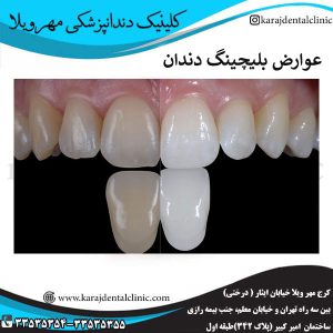 عوارض بلیچینگ دندان _ کلینیک مهرویلا