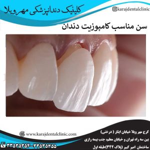 سن مناسب کامپوزیت دندان _ کلینیک مهرویلا