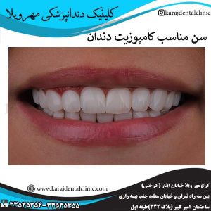 سن مناسب کامپوزیت دندان _ کلینیک مهرویلا
