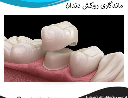 ماندگاری روکش دندان چقدر است ؟+ روش های افزایش طول عمر روکش دندان
