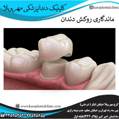 ماندگاری روکش دندان چقدر است ؟ | کلینیک دندان پزشکی مهرویلا
