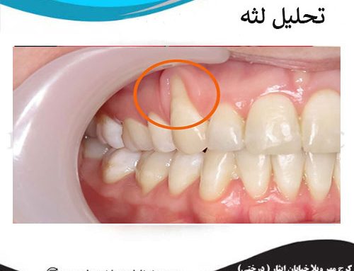 تحلیل لثه چه علائمی دارد ؟ + 6 علت اصلی تحلیل لثه