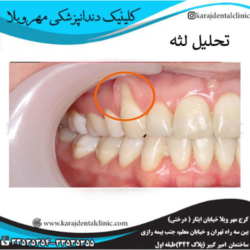 علائم اصلی تحلیل لثه _ کلینیک مهرویلا