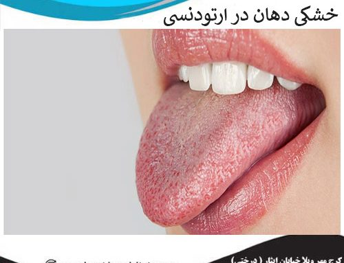 روش درمان خشکی دهان در ارتودنسی