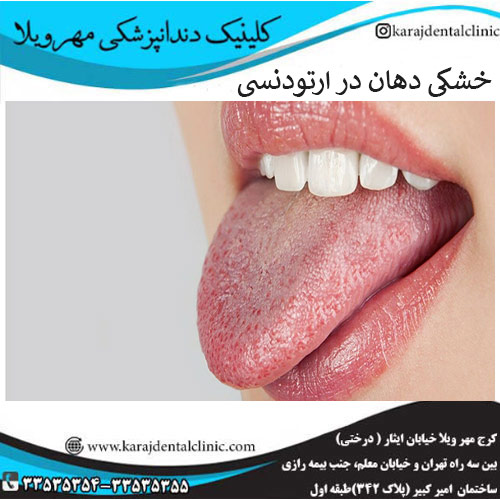 خشکی دهان در ارتودنسی _ کلینیک مهرویلا