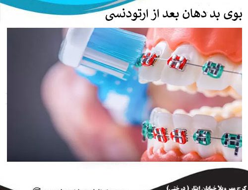 روش رفع بوی بد دهان در ارتودنسی | علت بوی بد دهان در ارتودنسی