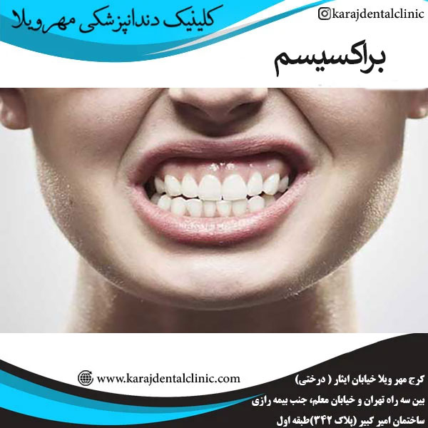 براکسیسم یا دندان قروچه _ کلینیک مهرویلا