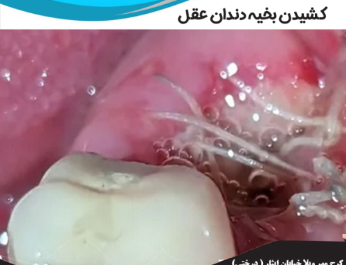 کشیدن بخیه دندان عقل | زمان مناسب کشیدن بخیه دندان عقل