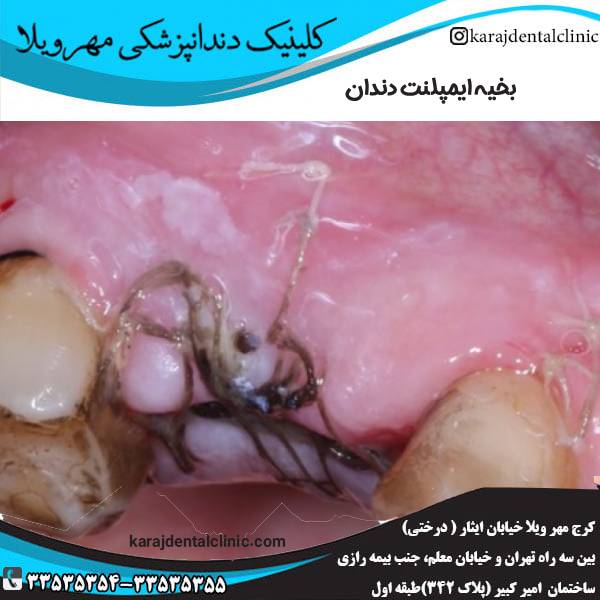 بخیه ایمپلنت دندان