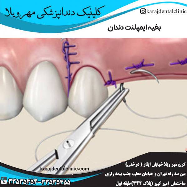 بخیه ایمپلنت دندان