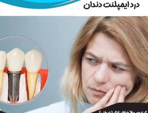 درد بعد از ایمپلنت | شدت درد ایمپلنت چقدر است؟