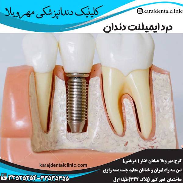 درد ایمپلنت دندان