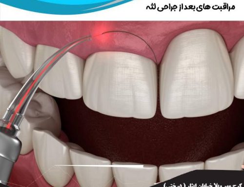 مراقبت های بعد از جراحی لثه | باید ها و نباید ها بعد از عمل لثه