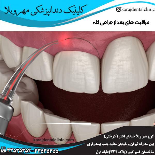 مراقبت های بعد از جراحی لثه